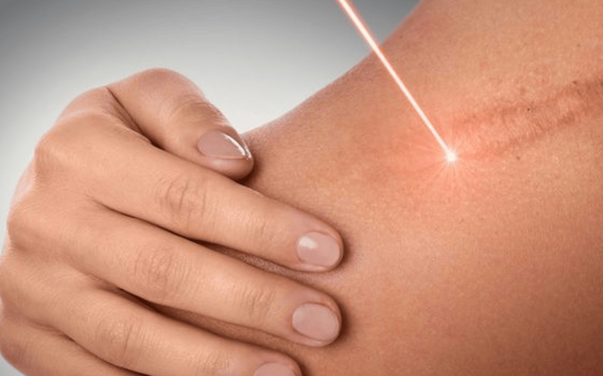 LASER Scar Treatment 